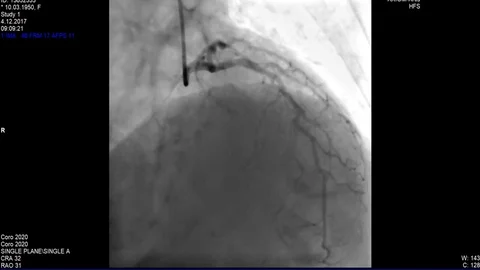 Cardiac Coronary angiogram Stock Footage 83428948