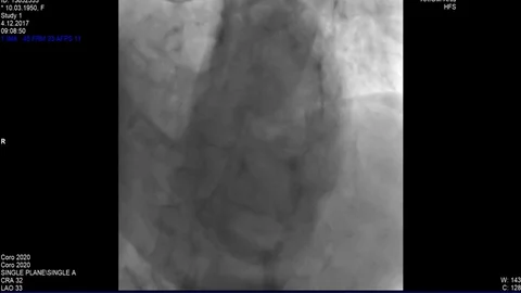 Cardiac Coronary angiogram Stock Footage 83428949