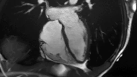 Cardiac MRI of Beating Heart Stock Footage