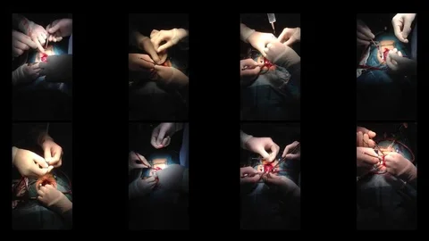Cardiac surgery beating heart Stock Footage 74215220