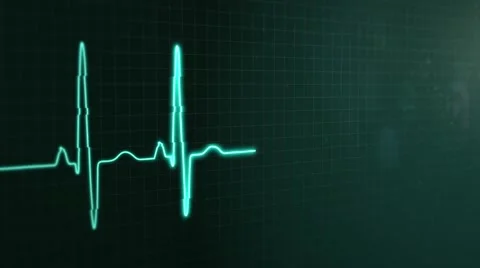 A cardio monitor shows а cardiogram on its screen with a signal disturbances Stock Footage
