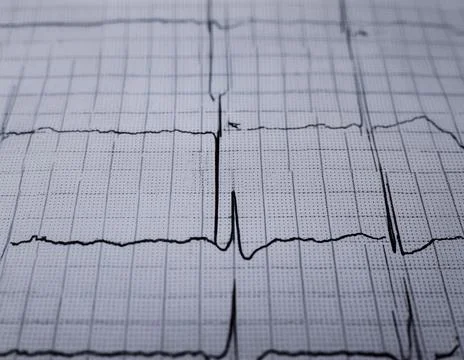 Cardiogram chart (ECG) Stock Photos