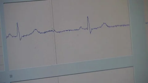 Cardiogram chart Stock Footage 148461975