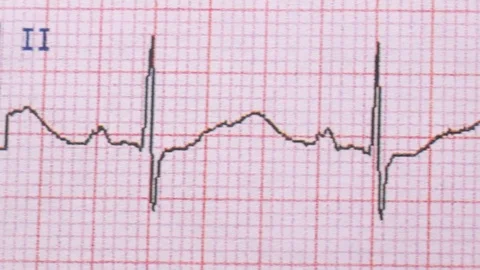 Cardiogram of the heart Stock Footage 121523613