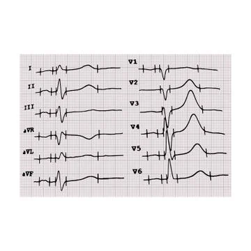 Cardiogram. Heartbeat. The graph on graph paper. Vector illustration on isolated Stock Illustration