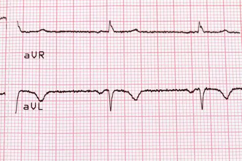 Cardiogram on paper Stock-Fotos