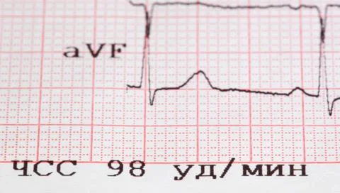 Cardiogram Stock Photos