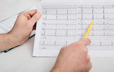 Cardiogram test, close-up of ECG report. Doctor analyzes cardiogram results o Stock Photos