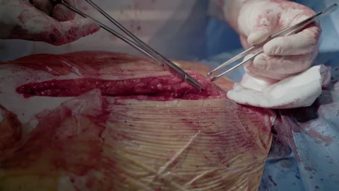 Cardiosurgeons perform aorto-coronary bypass surgery Video stock 104919853