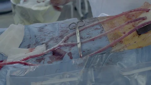 Cardiosurgeons perform a cut with the help of a coagulator. Aorto-coronary Stock Footage 104919525