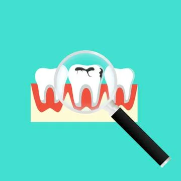 Caries dental problems. Tooth with caries icon with magnifier. Big hole in th Stock Illustration