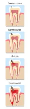 Caries Development Stages Cross Sections Tooth Decay Illustrazione stock
