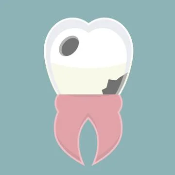 Caries Stock Illustration