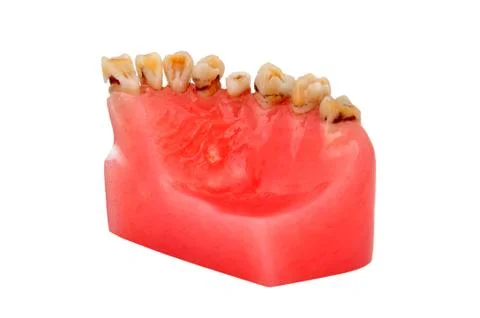 Caries Foto stock