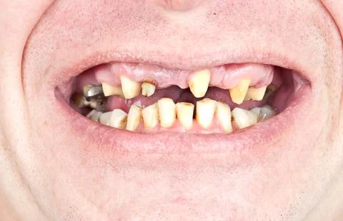 Caries Stock Photos