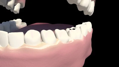 Caries Removal Stock Footage 121560258