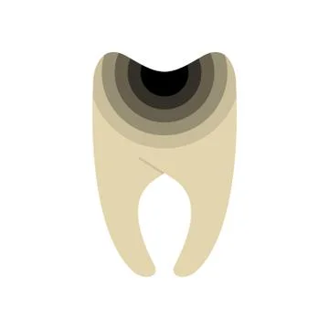 Caries Sick tooth isolated. Black hole in teeth. Stockillustratie