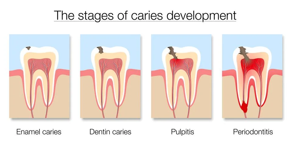Caries Stages Development Tooth Decay Cross Sections Illustrazione stock