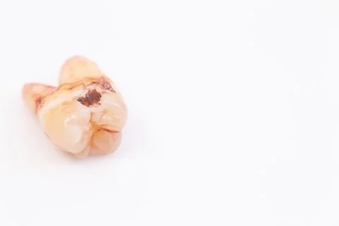 Caries on the teeth on the white background Stock Photos
