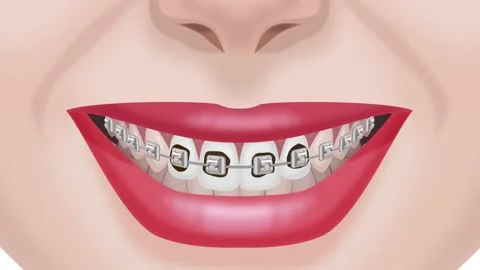 Caries under braces Stock Footage 151020635