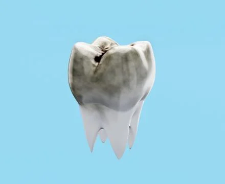 Carious molar tooth on blue background, tooth decay concept, caries Stock Illustration
