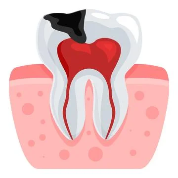 Carious tooth showing pulpitis and gum disease illustration Stock Illustration