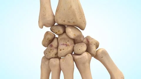 Carpal bones non displaced bone fracture fracture of 3d illustration Stockillustratie