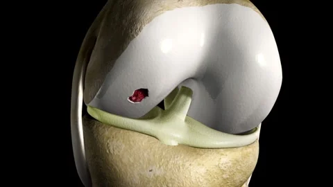 Cartilage tissue damage and knee joint injury visualized 库存影片 345199031