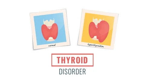 Cartoon animation of photo frames of hyperthyroid and healthy glands. Stock Footage 119791977
