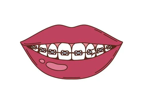 Cartoon groovy smiling lips with teeth with braces Stock Illustration
