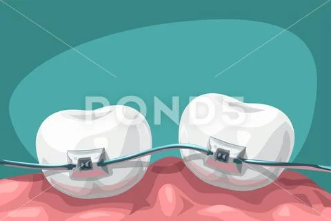 Cartoon teeth with steel braces Stock Illustration