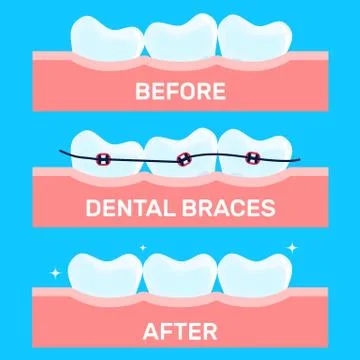 Cartoon teeth vector illustration, before and after brace correction. Concept of Stock Illustration
