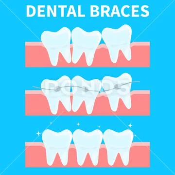 Cartoon teeth vector illustration, before and after brace correction. Concept of Stock Illustration