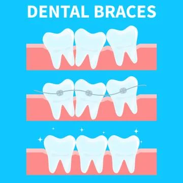 Cartoon teeth vector illustration, before and after brace correction. Concept of Stock Illustration