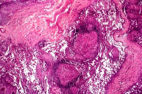Caseous pneumonia, light micrograph Stock Photos