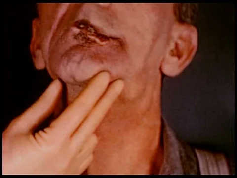 Cases of extensive diffuse Leukoplakia are often associated with Syphilis, and Stock Footage 75000310