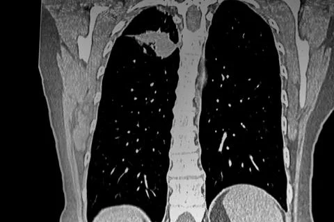 Cat Scan of frontal upper right lobe lung tumor. Stock Photos