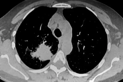 Cat Scan of frontal upper right lobe lung tumor. Stock Photos
