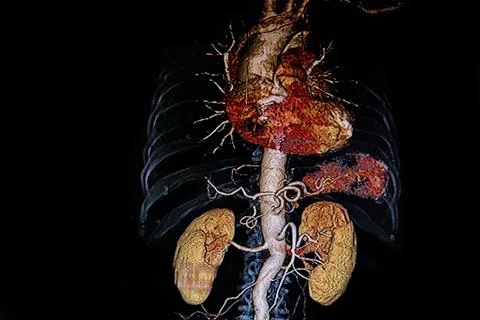 CAT Scan image of Thoracoabdominal Foto stock
