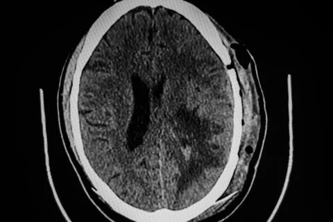 CAT - Scan left hemisphere  brain tumor Stock Photos