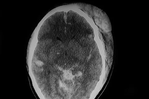 CAT Scan of severo skull Brain trauma Stock Photos