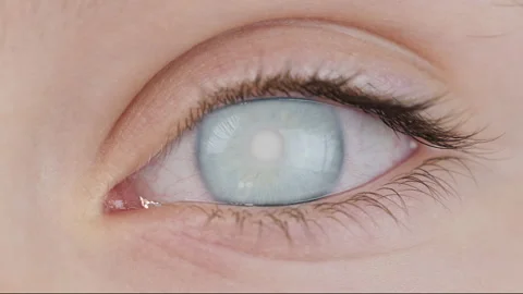 Cataract corneal opacity 库存影片 252138123