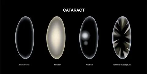 Cataract eye disease Stockillustratie