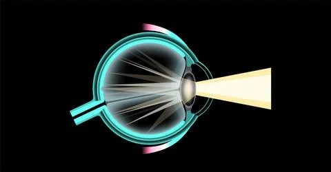 Cataract eye disease Stockillustratie
