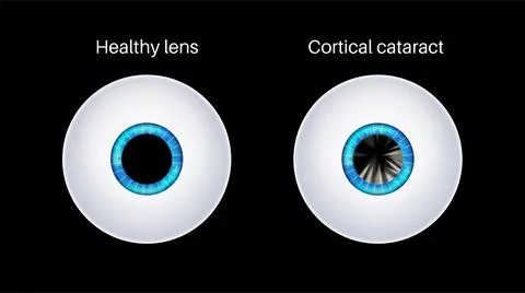 Cataract eye disease Stock Illustration