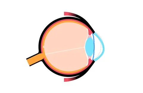 Cataract eye disease Stock Illustration