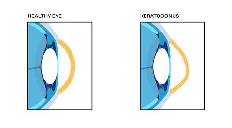 Cataract eye disease Stock Illustration