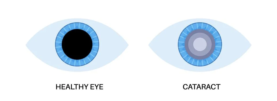 Cataract eye disease Stockillustratie