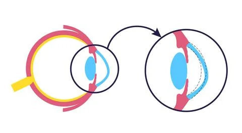 Cataract eye disease Stockillustratie