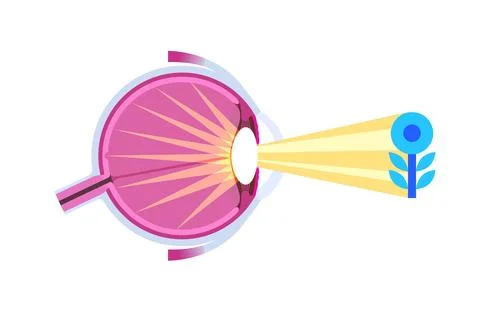Cataract eye disease Stockillustratie
